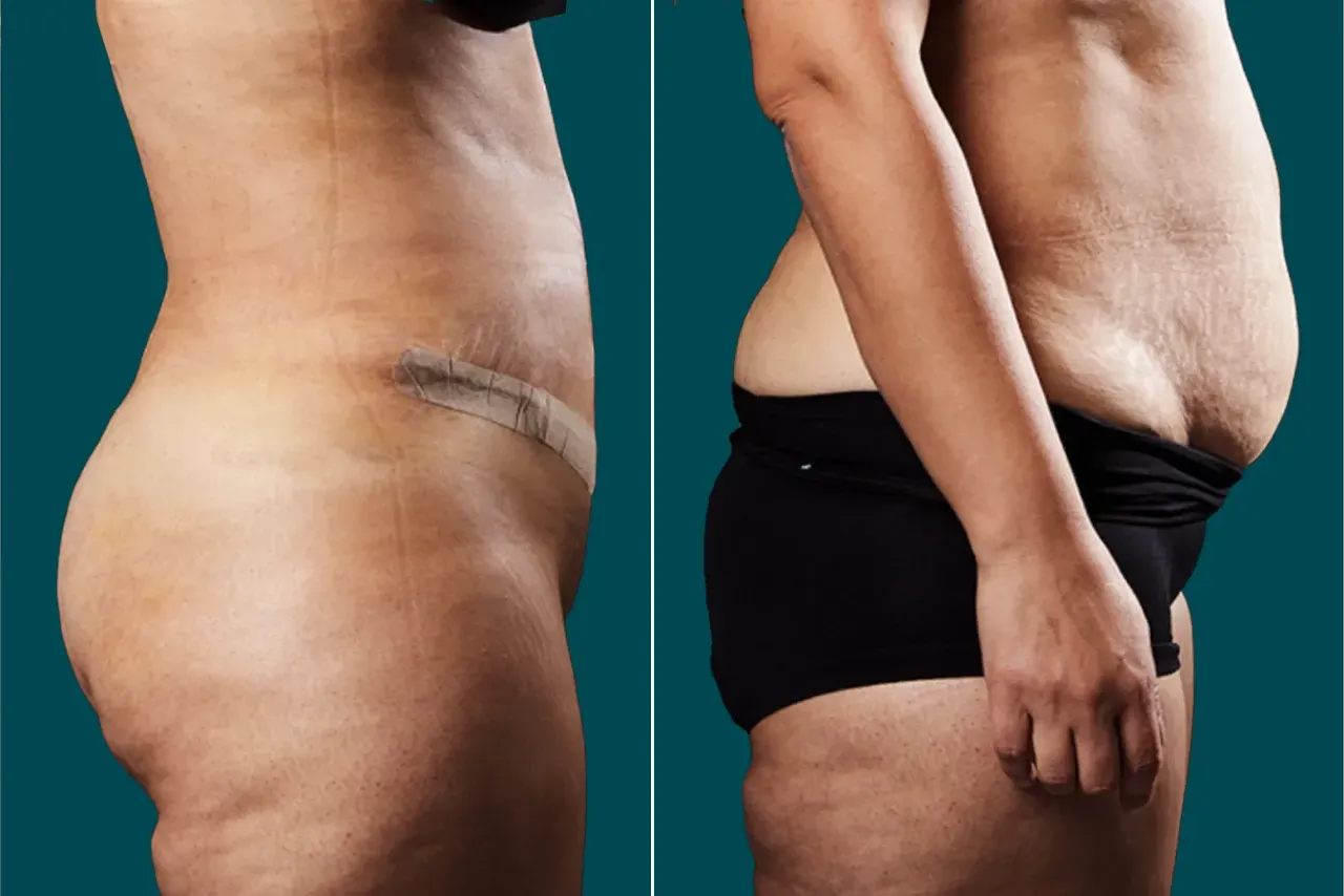 Liposuction Before and After 12