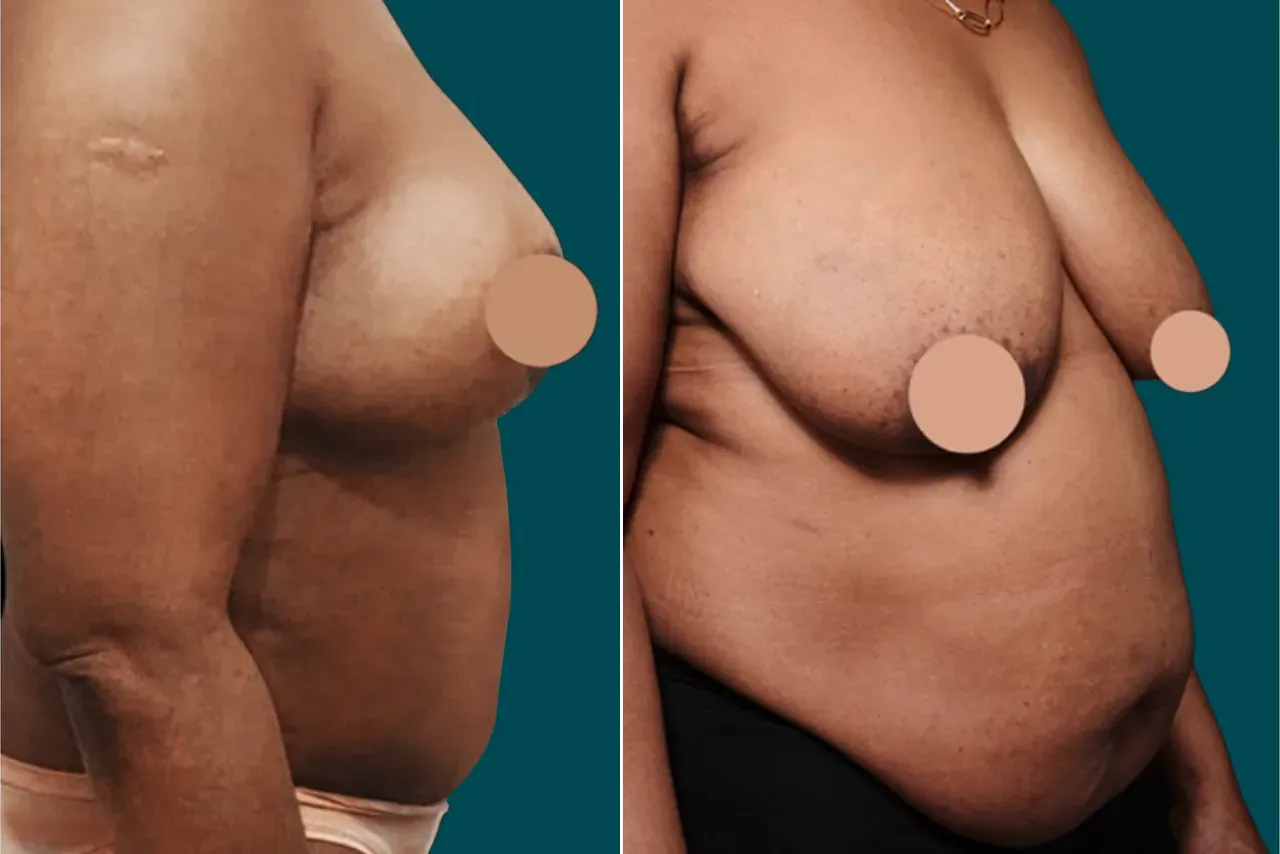 Liposuction Before and After 13
