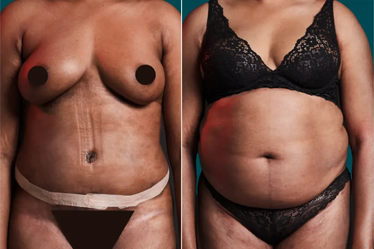 Liposuction Before and After 14