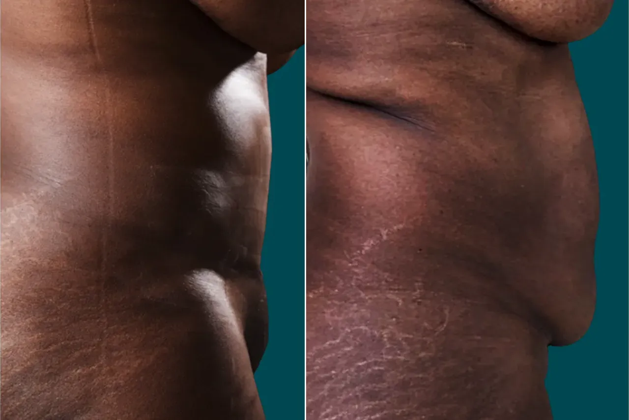 Liposuction Before and After 15