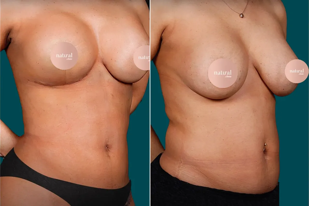 Liposuction Before and After 16