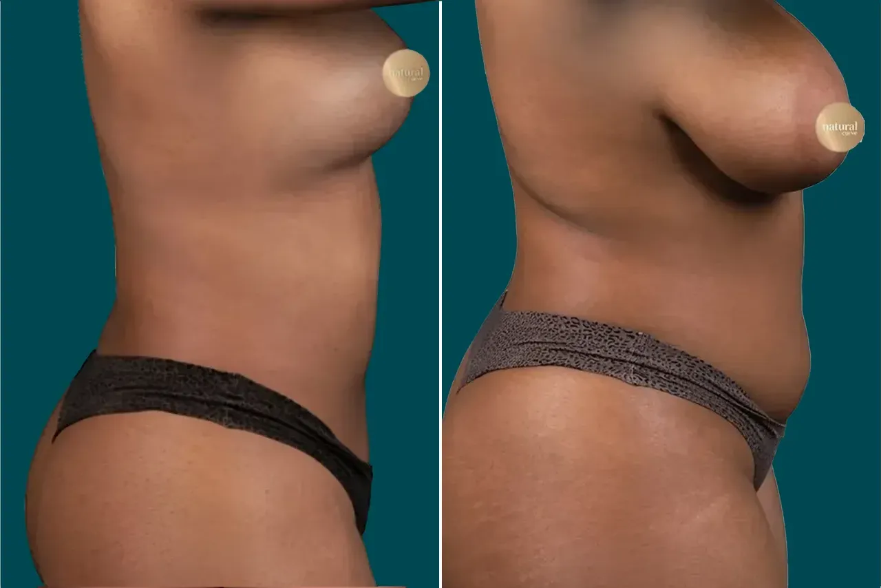 Liposuction Before and After 2