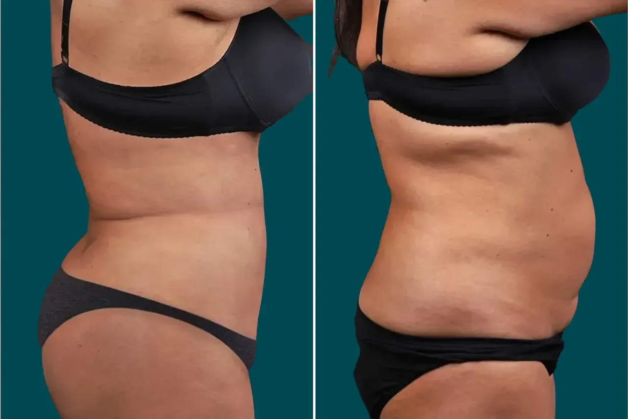 Liposuction Before and After 3
