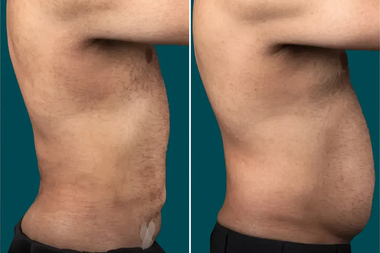 Liposuction Before and After 4