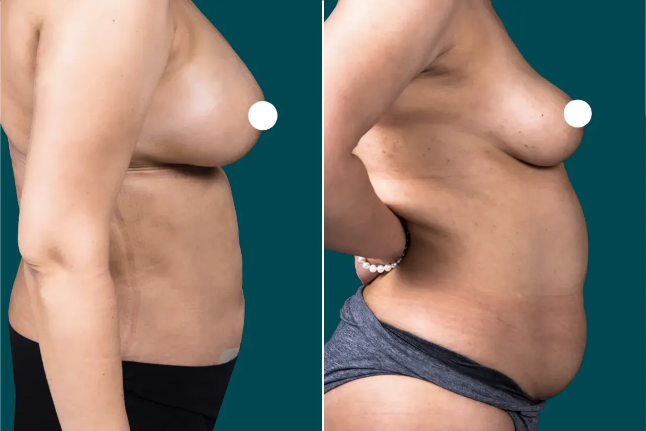 Liposuction Before and After 5