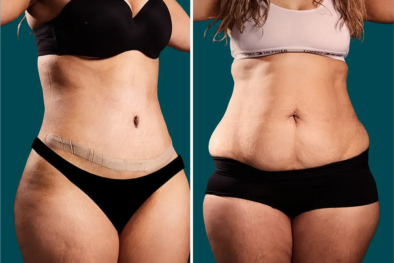 Liposuction Before and After 6
