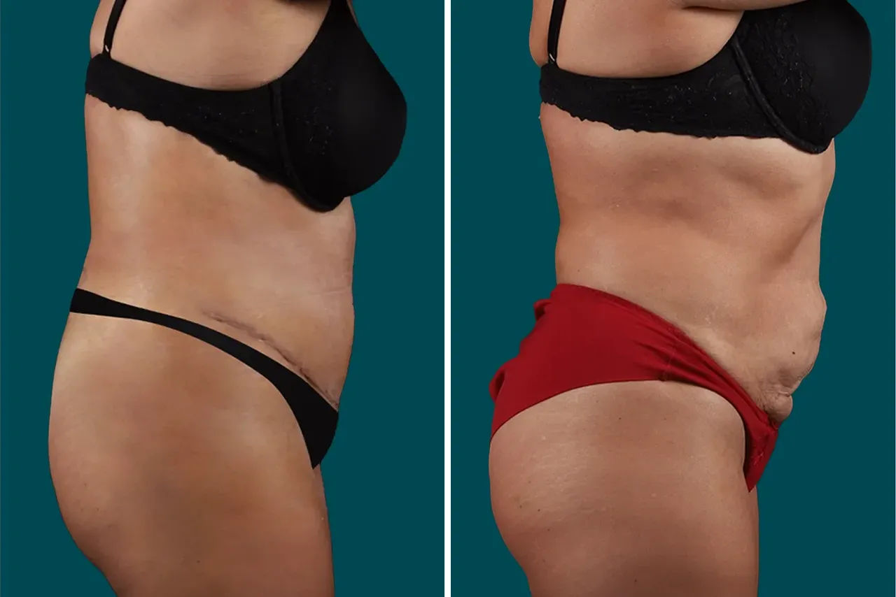 Liposuction Before and After 7