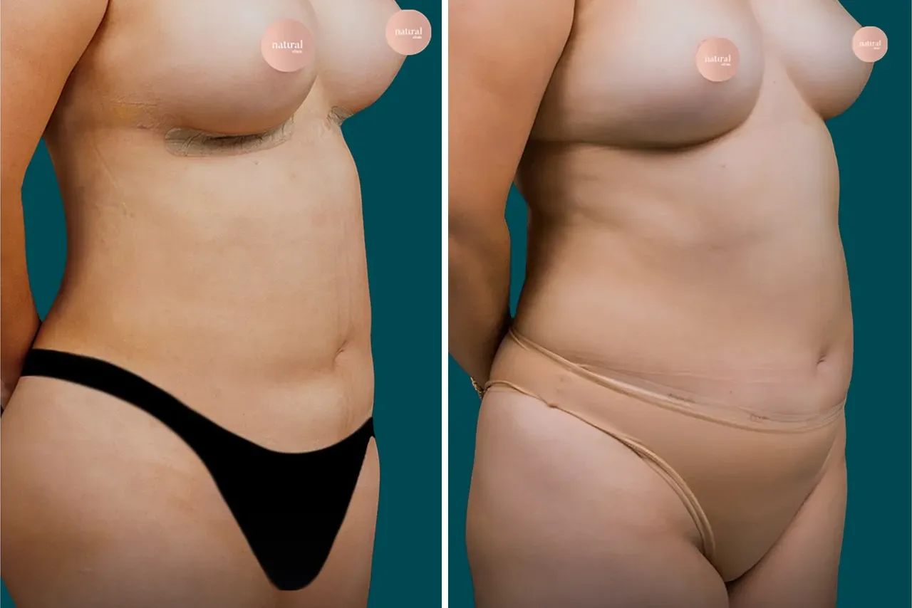 Liposuction Before and After 8