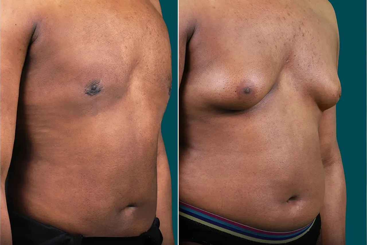 Liposuction Before and After 9