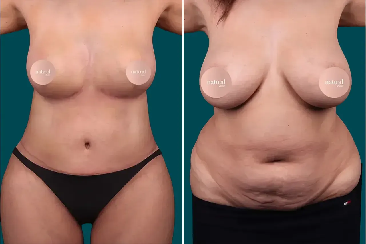 Mommy Makeover Before and After 1