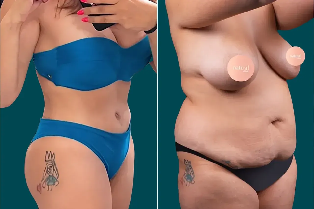 Mommy Makeover Before and After 3