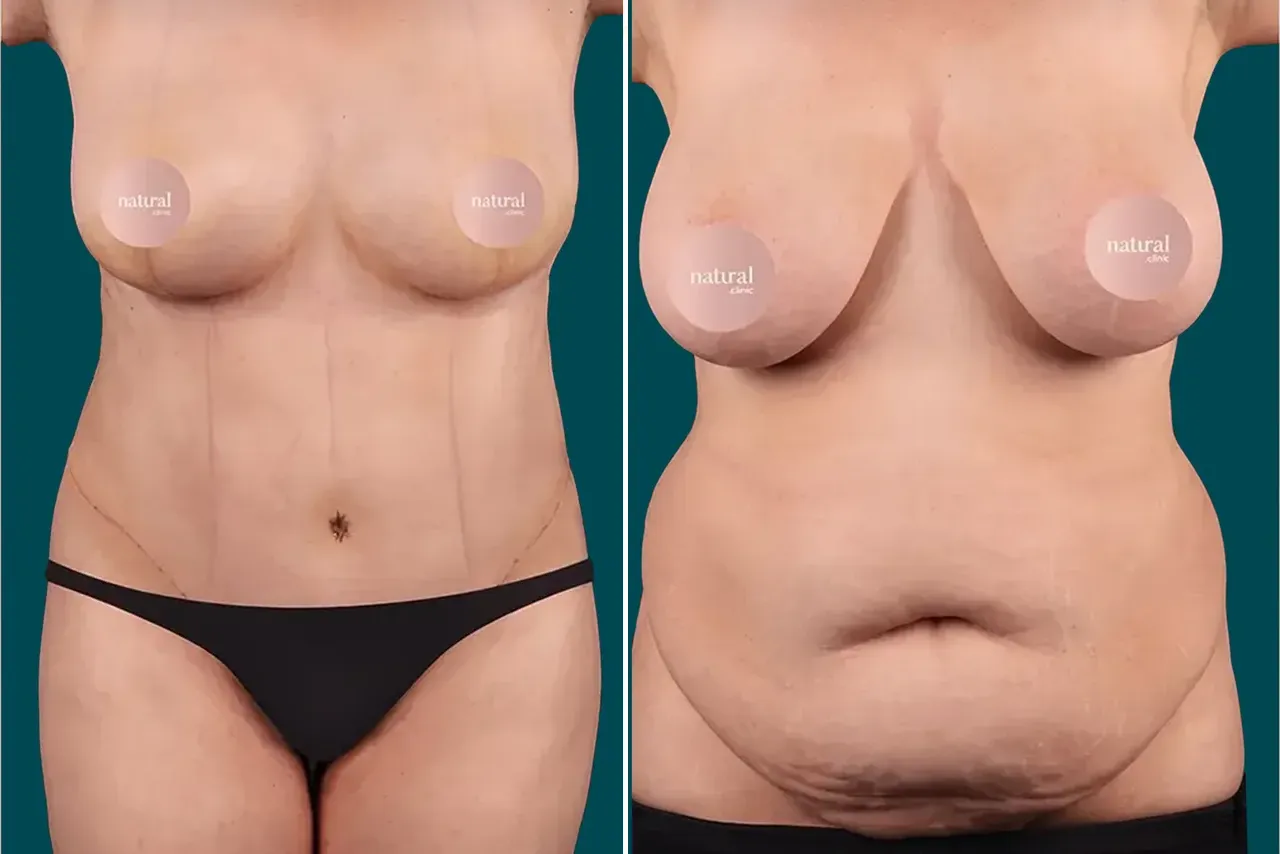 Mommy Makeover Before and After 4