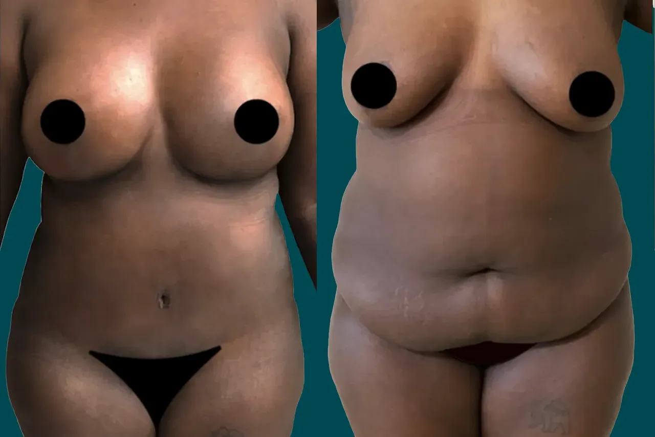 Mommy Makeover Before and After 5
