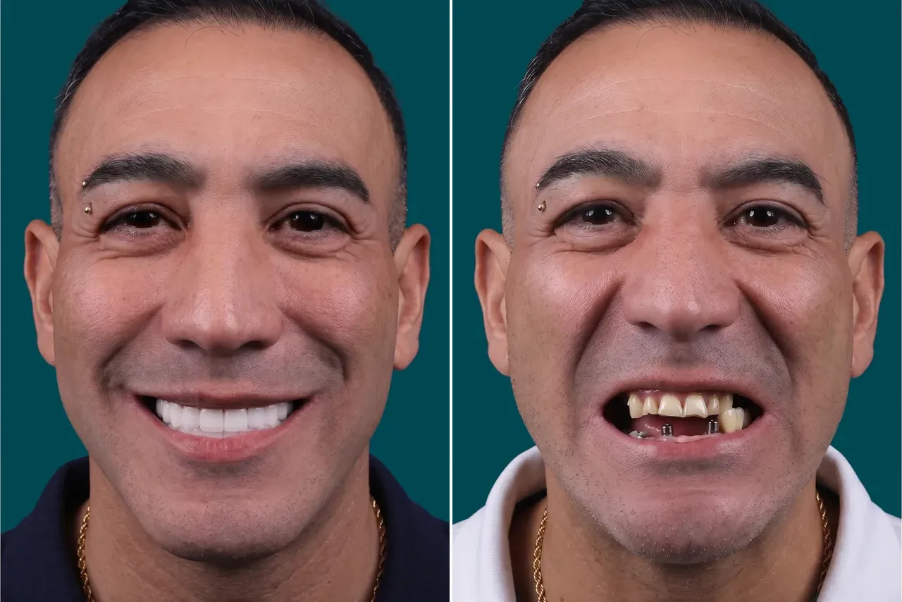 Dental Implants-Multiple Dental Implants 4