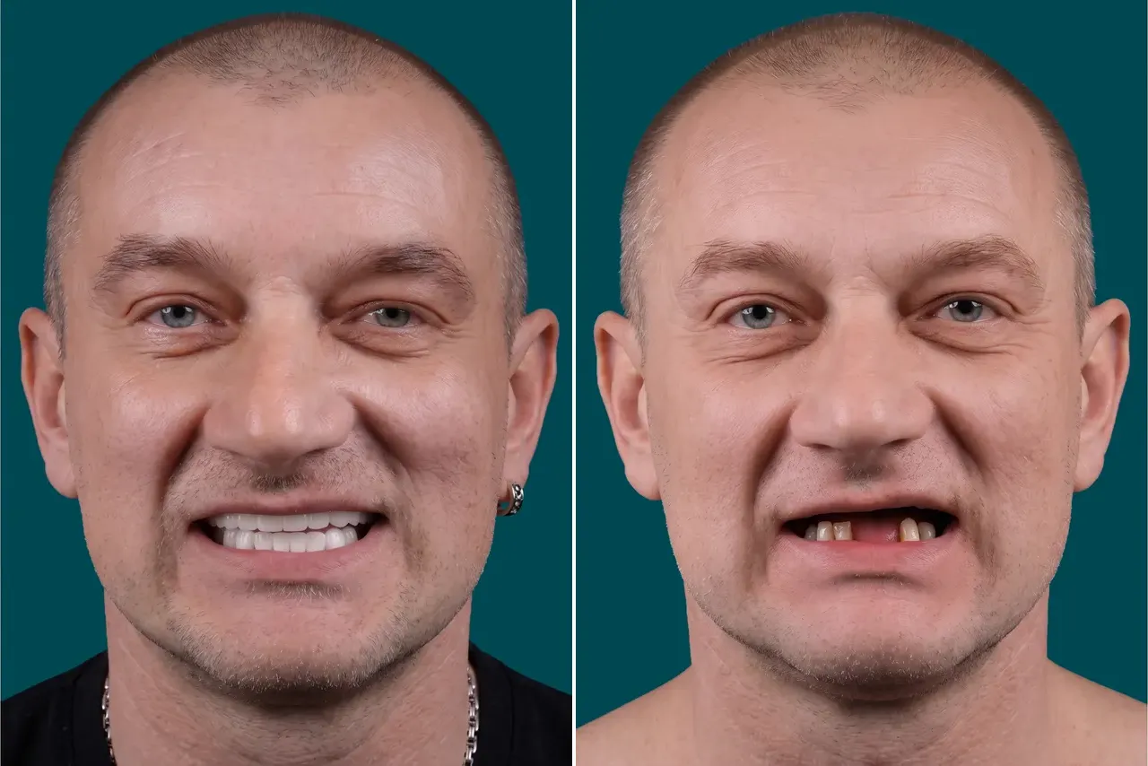 Dental Implants-Multiple Dental Implants 2