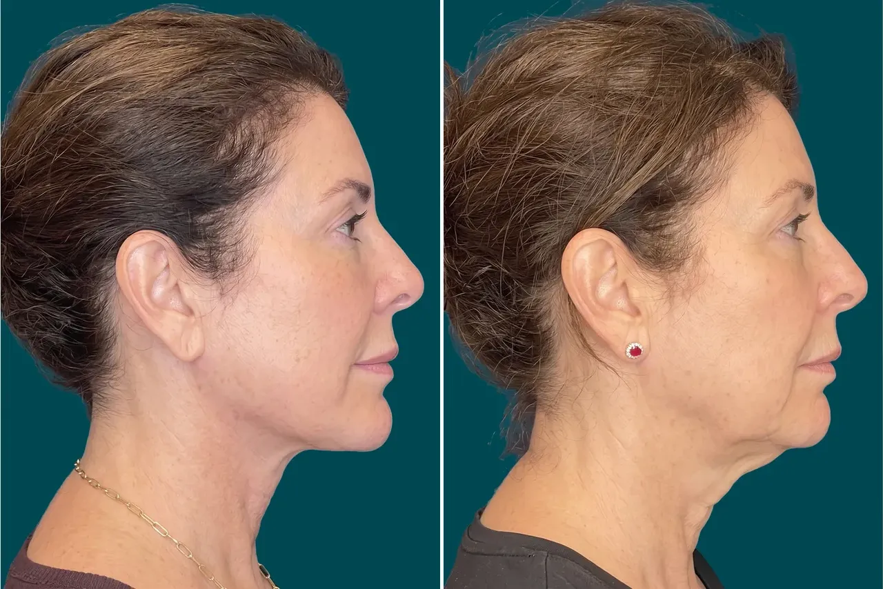 Neck Lift Before and After 3