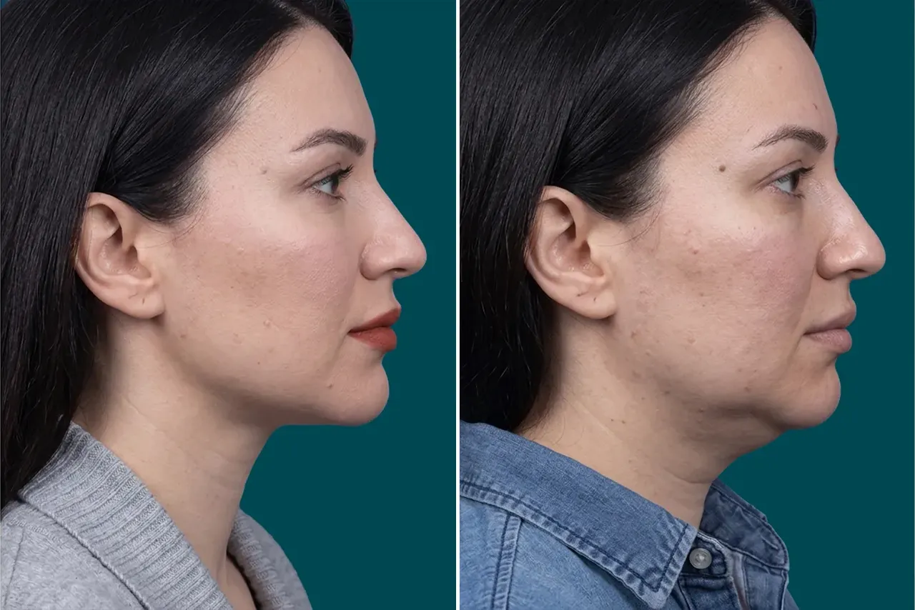 Neck Lift Before and After 4