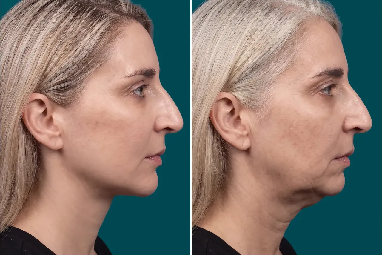 Neck Lift Before and After 6