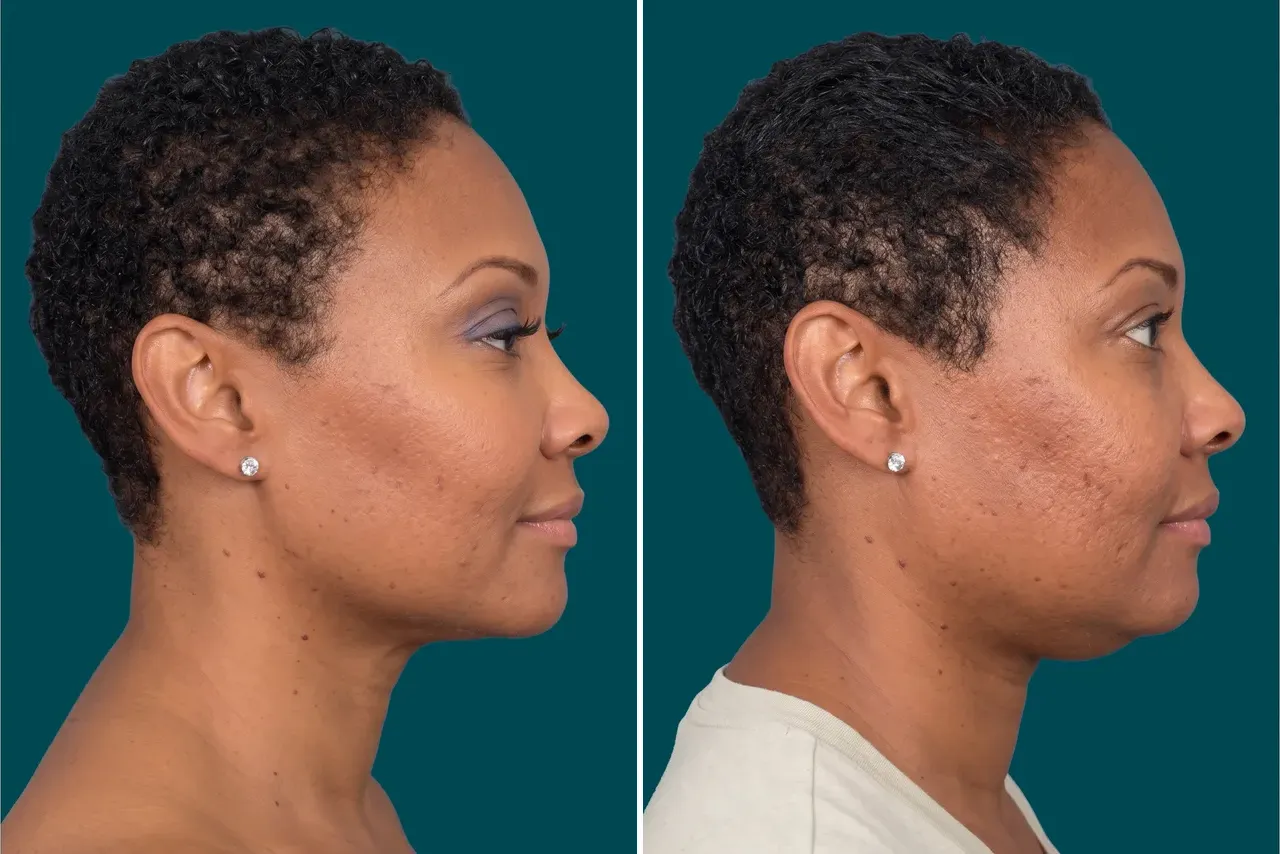Neck Lift Before and After 7