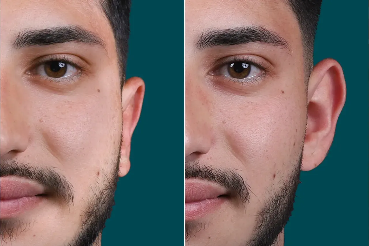 Otoplasty Before and After 1