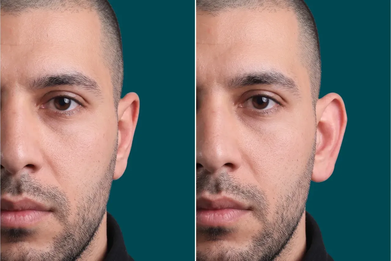 Otoplasty Before and After 3