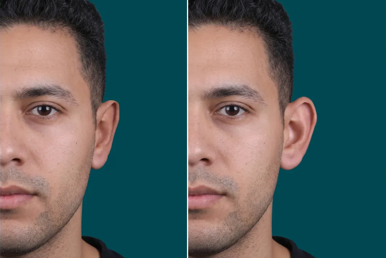 Otoplasty Before and After 4