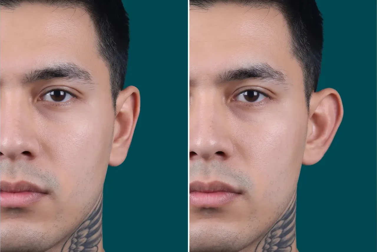 Otoplasty Before and After 5