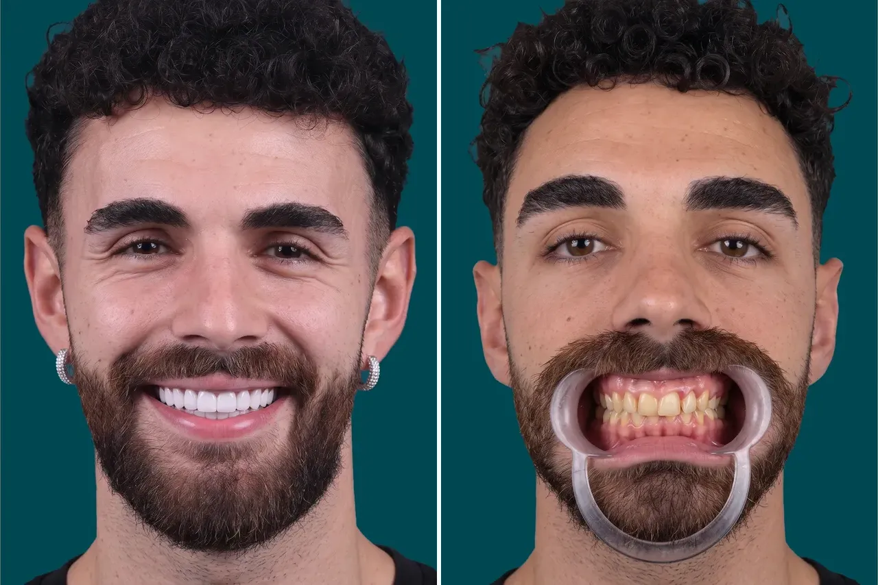 Dental Treatments-Porcelain Crowns 