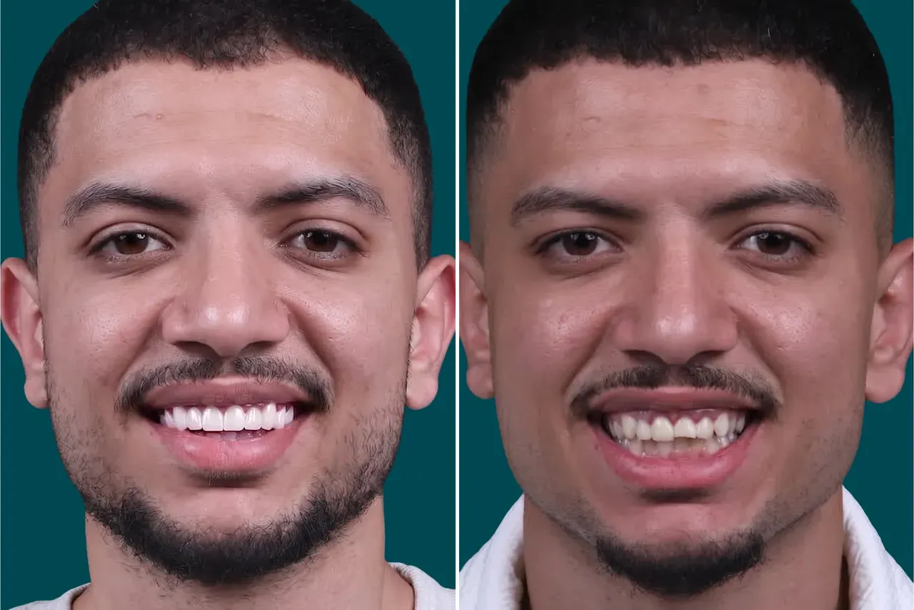 Dental-Crowns-Porcelain Crowns 2