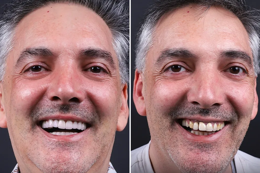 Dental-Crowns
