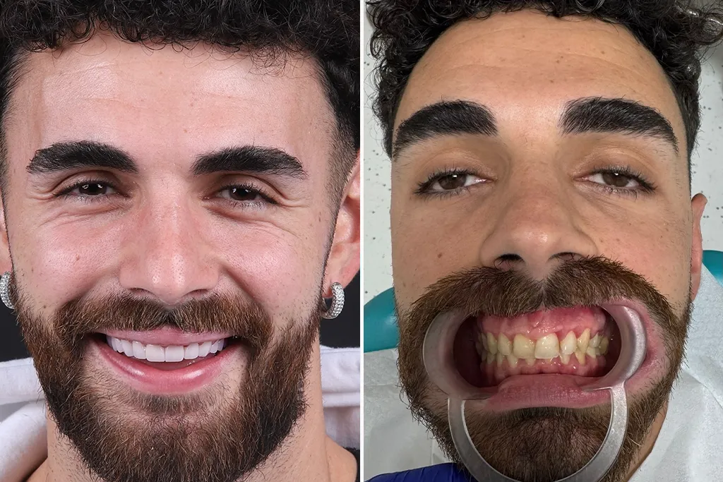 Dental-Crowns