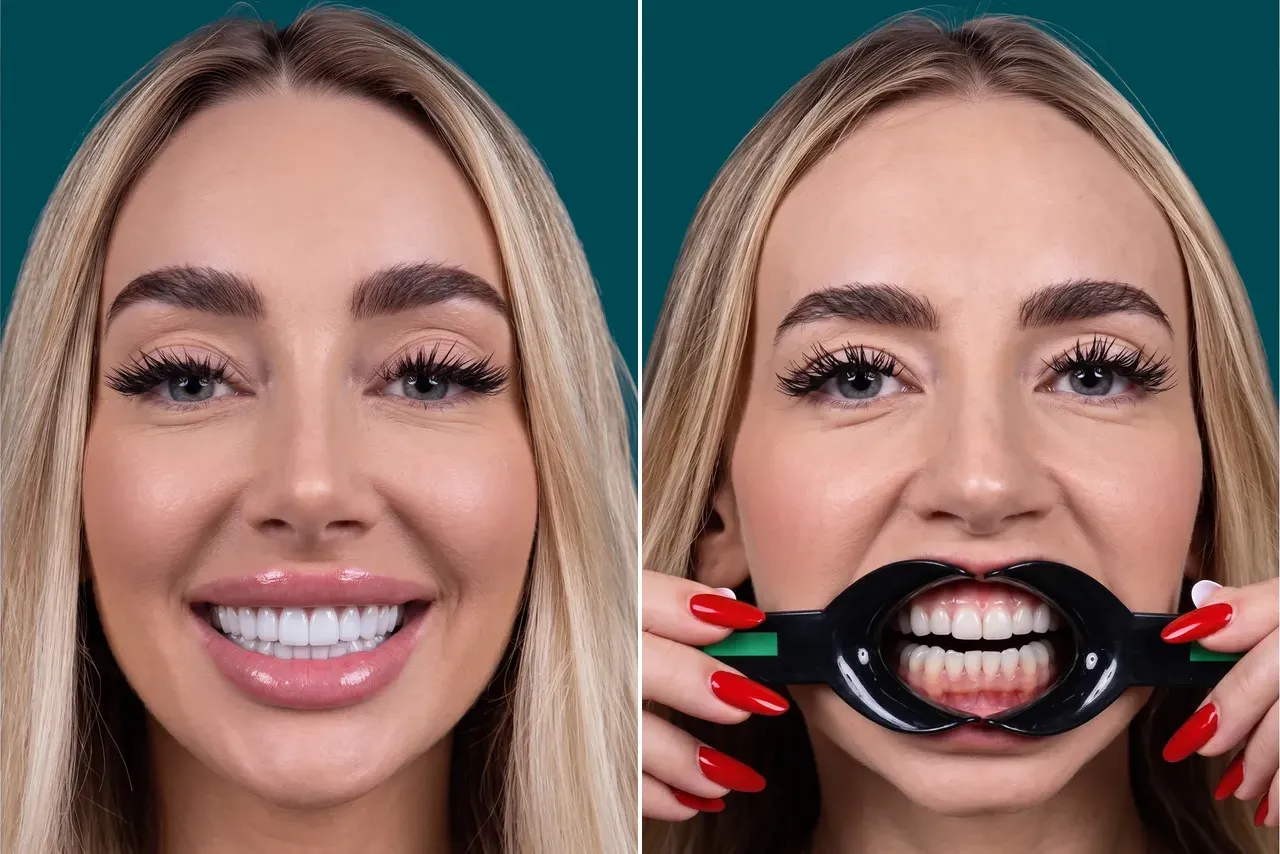 Dental Veneers-Porcelain Veneers 4