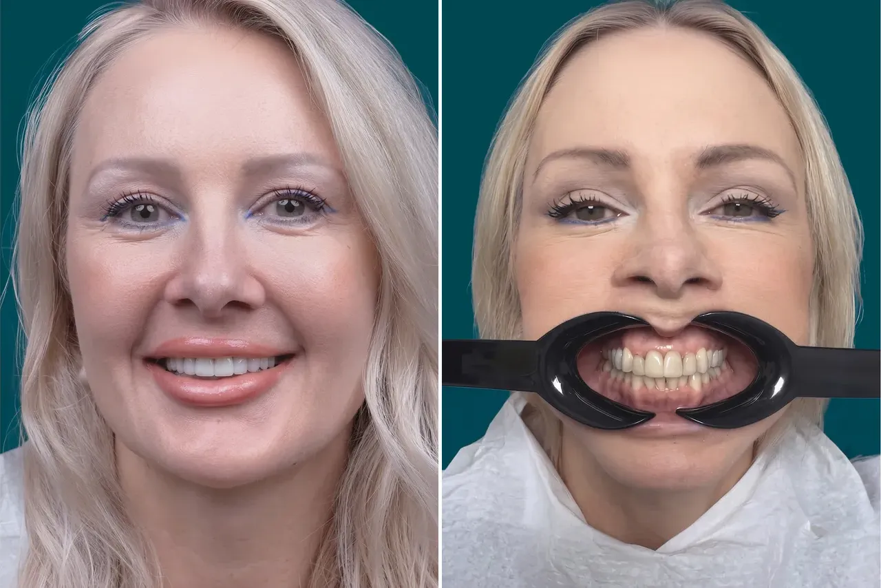 Dental Veneers-Porcelain Veneers 5
