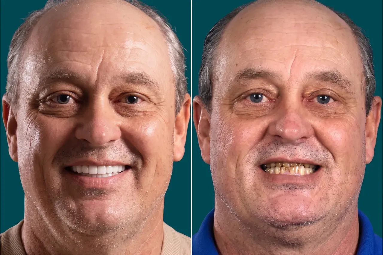 Dental Veneers-Porcelain Veneers 1