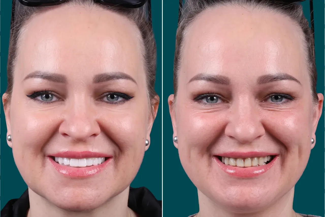 Dental Veneers-Porcelain Veneers 2