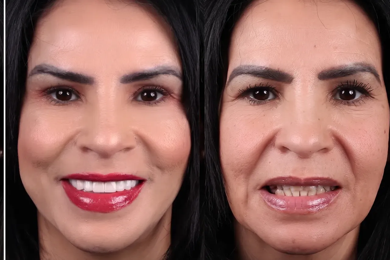 Dental Veneers-Porcelain Veneers 3