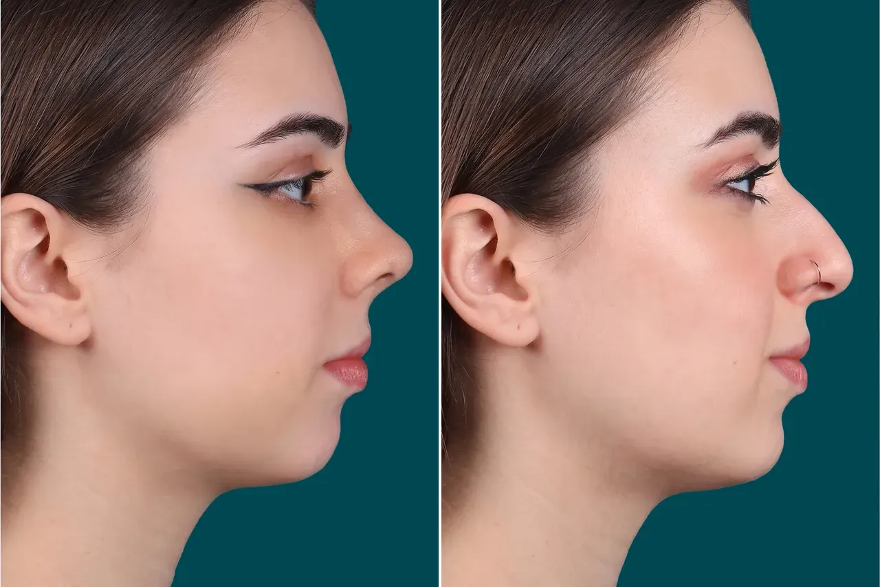 Rhinoplasty Before and After 2