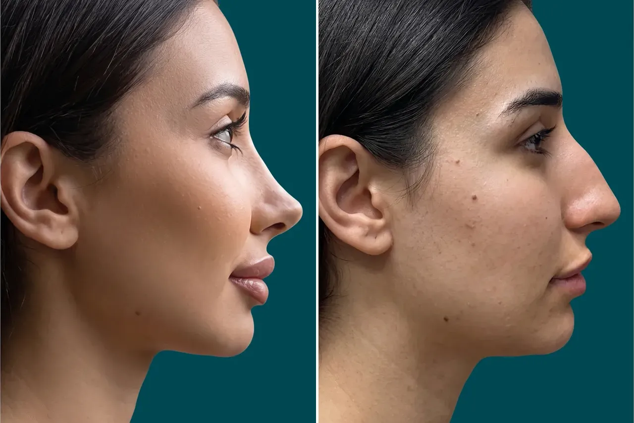 Rhinoplasty Before and After 10