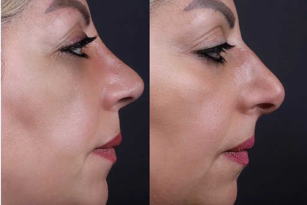 Rhinoplasty Before After In Turkey 11 (1)
