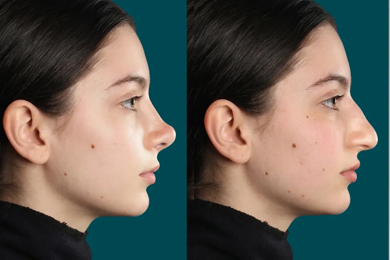 Rhinoplasty Before and After 11