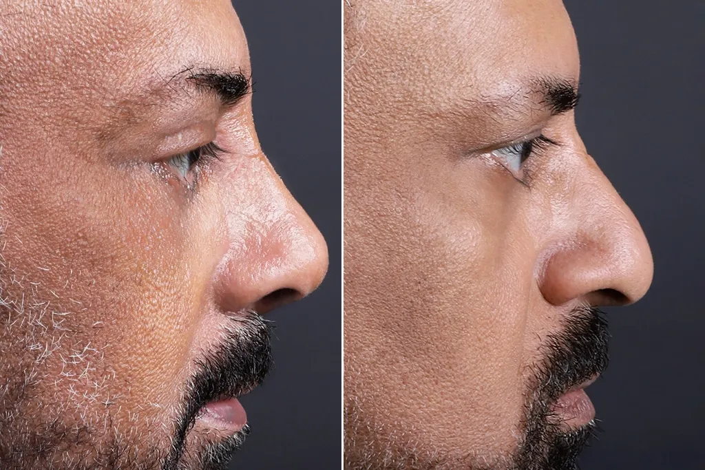 Rhinoplasty Before After In Turkey 12 (1)