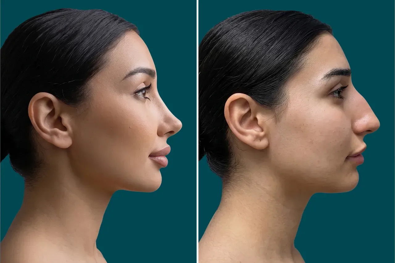 Rhinoplasty Before and After 12