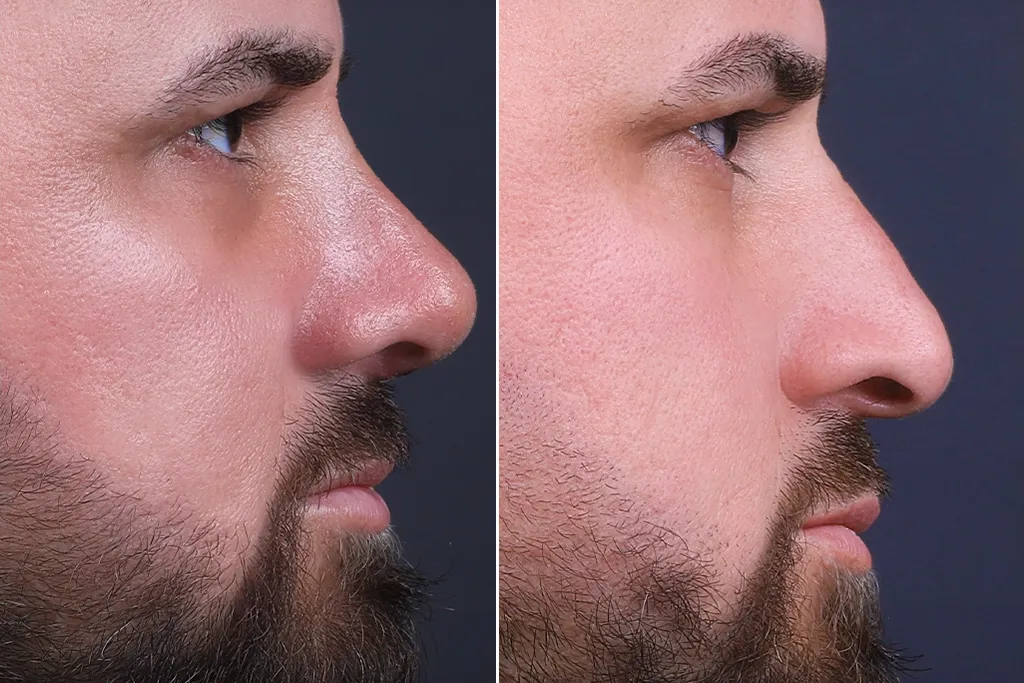 Rhinoplasty Before After In Turkey 13 (1)