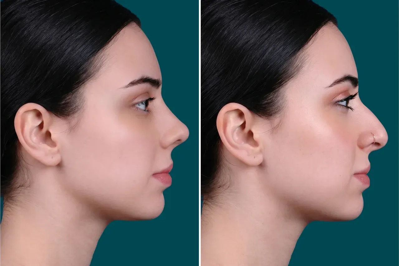 Rhinoplasty Before and After 13