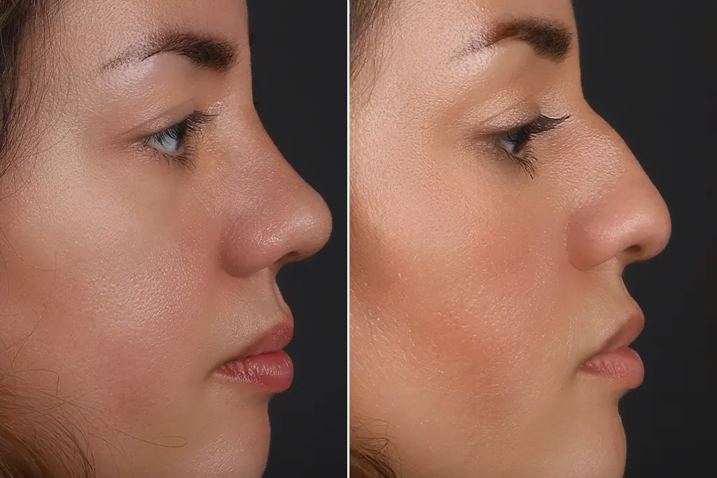Rhinoplasty Before After In Turkey 14 (1)