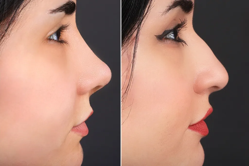Rhinoplasty Before After In Turkey 15 (2)