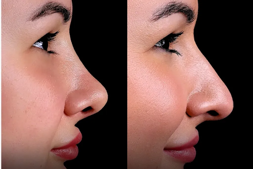 Rhinoplasty2