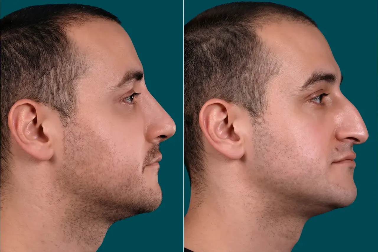 Rhinoplasty Before and After 3