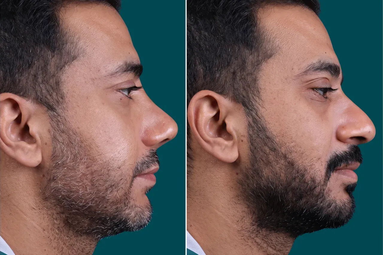 Rhinoplasty Before and After 5