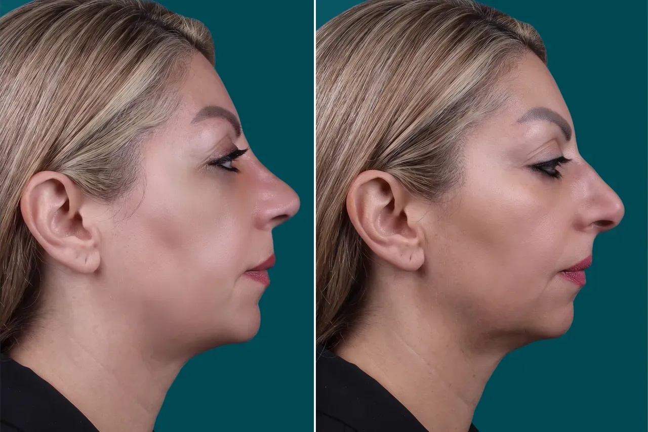 Rhinoplasty Before and After 6
